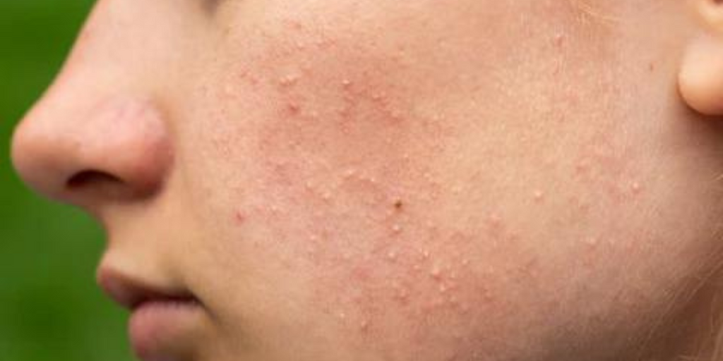 Types of Acne Vulgaris